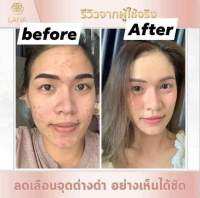 Lana Soap ( ဝက်ခြံ ၂ပတ်အတွင်း ပျောက်စေတယ် မျက်နှာသစ် ဆပ်ပြာ )