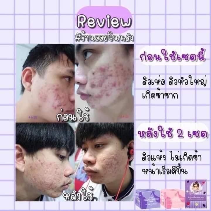 สาวกองุ่นมาจ้า-หน้าใส-ไร้สิว-ต้องโสมองุ่นค้าบ-น้องตะปุกจิ๋ว-แต่น้องประโยชน์เยอะน๊าา-ตะปุกม่วง-ครีมบำรุง-ลดปัญหาการเกิดสิว-หน้ากระจ่างใสมากยิ่งขึ้น-ลดรอยดำรอยแดง-รอยสิวจางลงเห็นได้ชัด-ครีมองุ่น-โสมองุ่