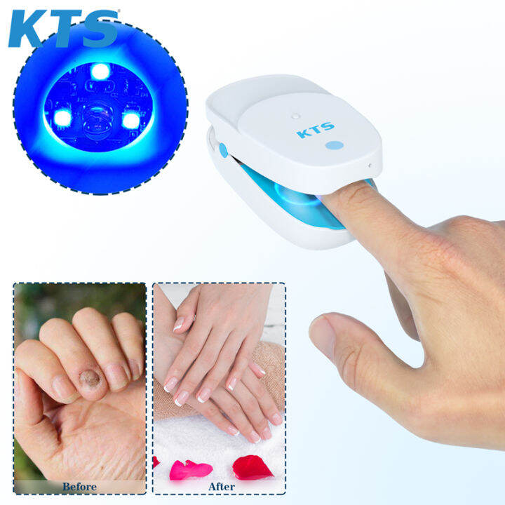KTS original Onychomycosis treatment of toenail fungus laser nail