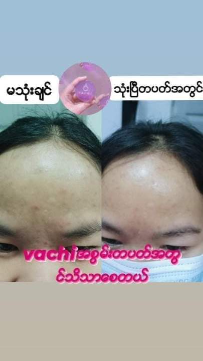 Vachi Soap Made In Thailand သာဘာဝ၆မ်ိဳးနဲ႔ Vitamin B3 Collagen Aqua တို့နဲ႔အေျခခံ