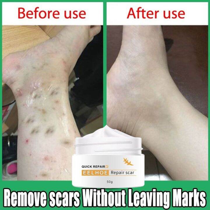Scar Repair Cream Scar Remover For Old Scar On Legs Pimple Marks
