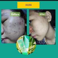 I Aura ဝက်ခြံ ပျောက် SkinCare set