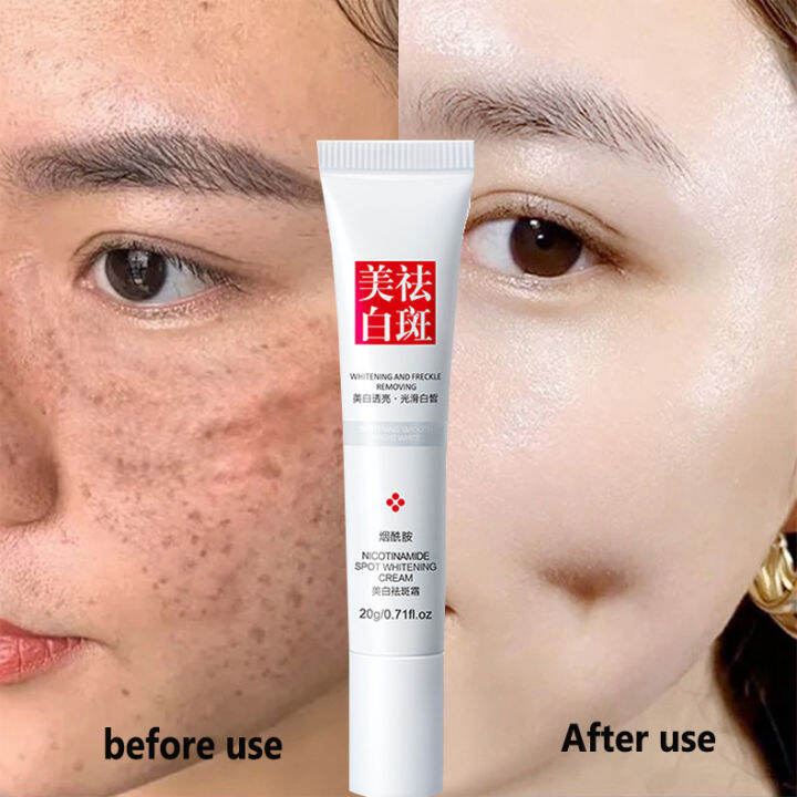 Freckle Remover Cream Whitening Freckle Cream Whitening Cream Dark