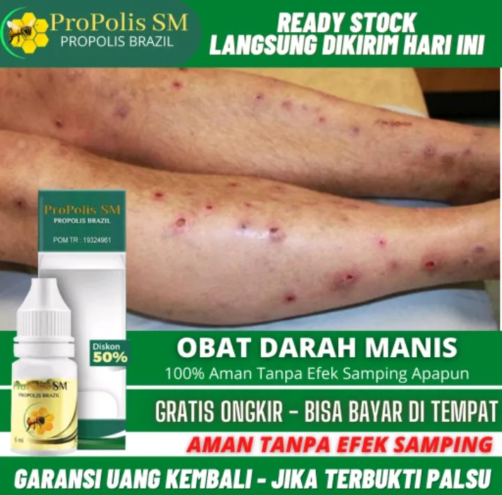 Salep Korengan Kaki Dan Tangan Obat Penghilang Bekas Luka Kulit Obat