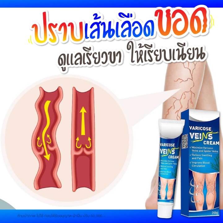 ครีมทาเส้นเลือดขอด-ของแท้-2-แถม-2-550-บาท-พร้อมส่ง-ในไทย-ขนาด20-กรัม