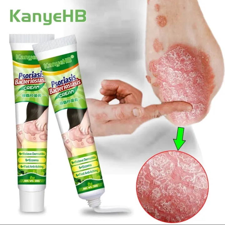 Flash Sale!💯 [proven Safe & Efective⭐] Original Kanyehb Psoriasis 