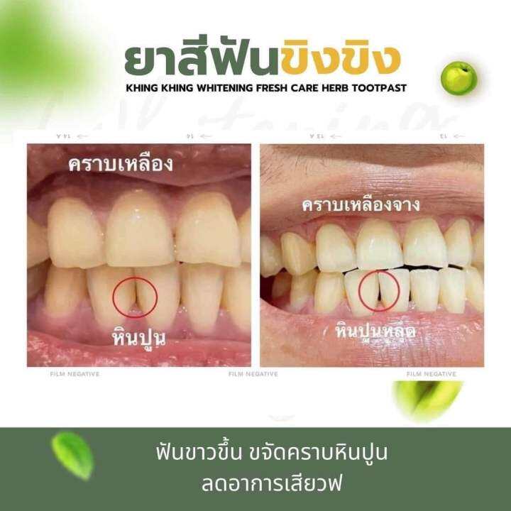 ยาสีฟันขิง-ขิง-1-แถม-1