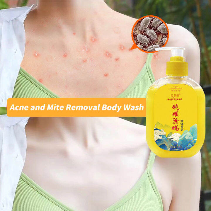 Acne body wash Sulfur Soap for Mite Removal Back Acne Removal Eczema