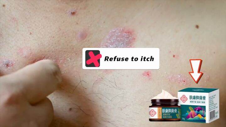 [One time to break the itch] skin to stop itching dry itch external