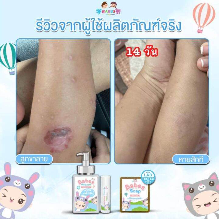 babes-body-gel-บาเบส-บอดี้-เจล-โลชั่นฟื้นฟูผิว-ลดรอยดำ-รอยแดง