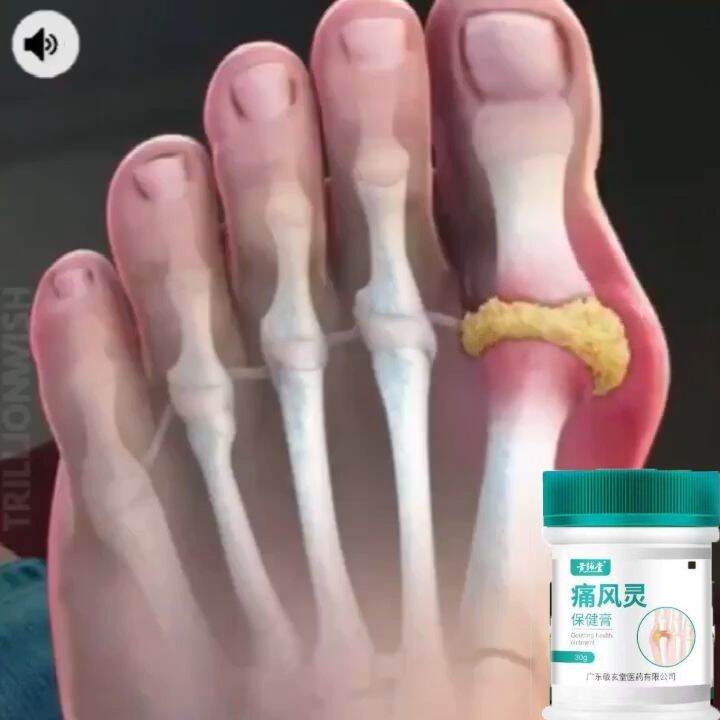 Gout ointment cream good for rayuma, foot, hand, finger and joint knee