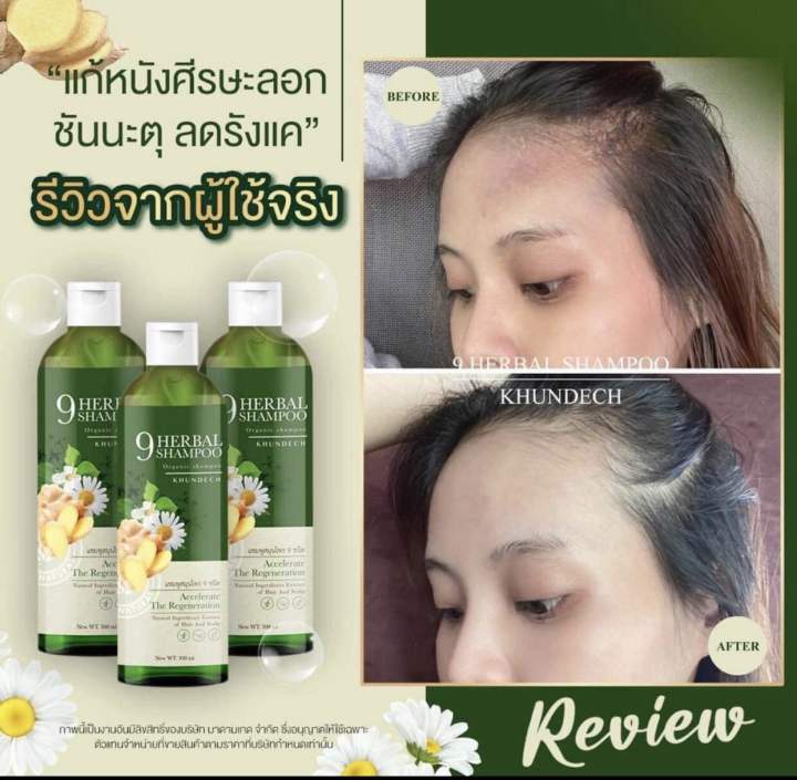 ส่งฟรีแชมพูขุนเดช-ลดอาการคัน-แห้งลอก