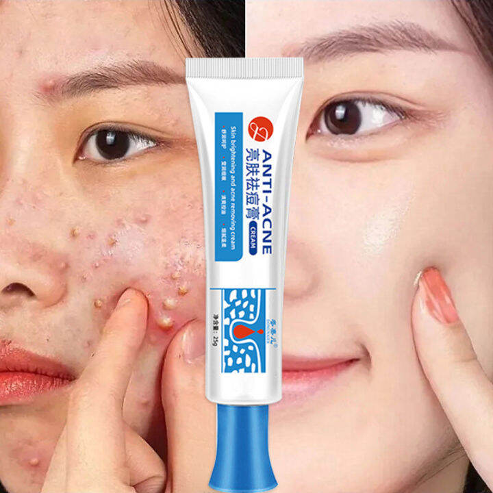 GL.25g Pimple Remover Cream Acne Removal Scar Marks Cream Acne