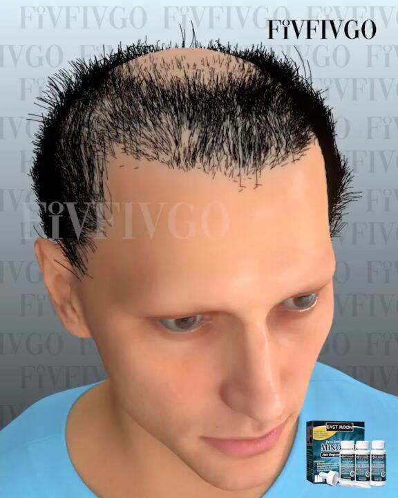 ONHAND ORIGINAL Kirkland Minoxidil Hair Regrowth Treatment Clinically