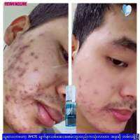 A  mor   Acne Skin Clean