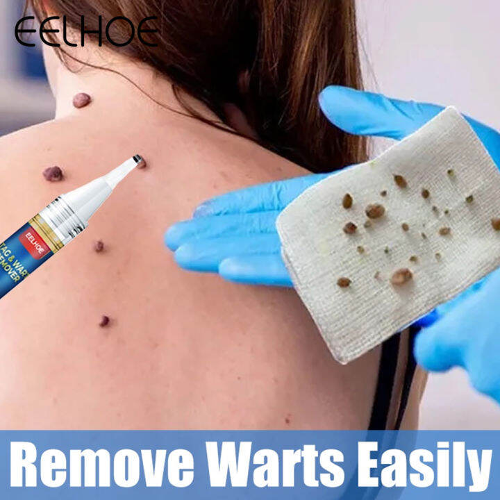 EELHOE Wart Removal Pen Anti-Moles Wart Remover Anti-Wart Remedy Pen ...