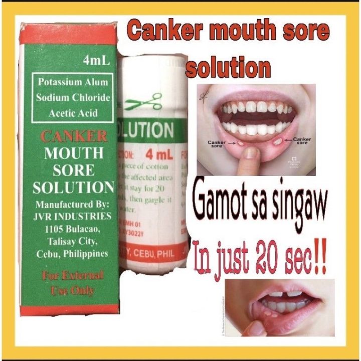 Canker Mouth Sore Solution Singaw Treatment 4ml | Lazada PH