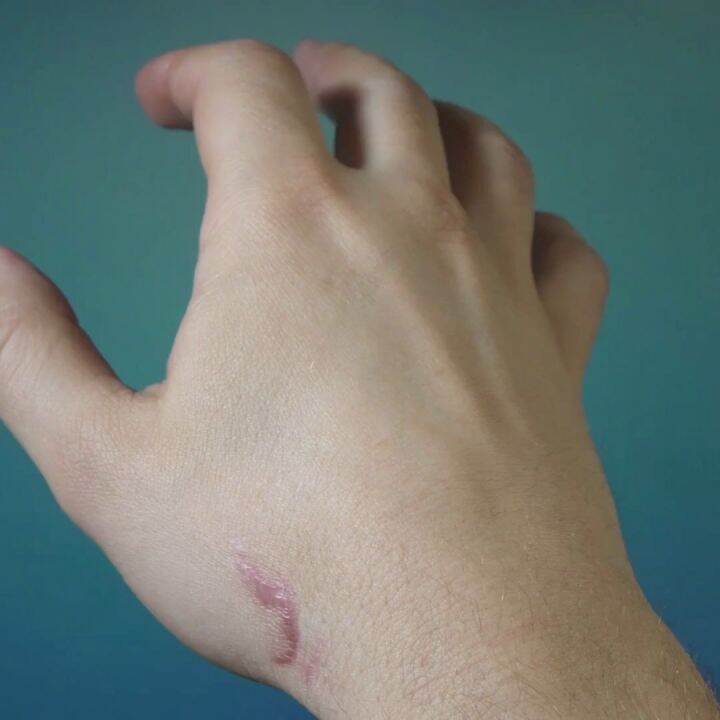 ScarCare Serum Lotion 70 mL Best Lotion for Scars Fades Acne Marks