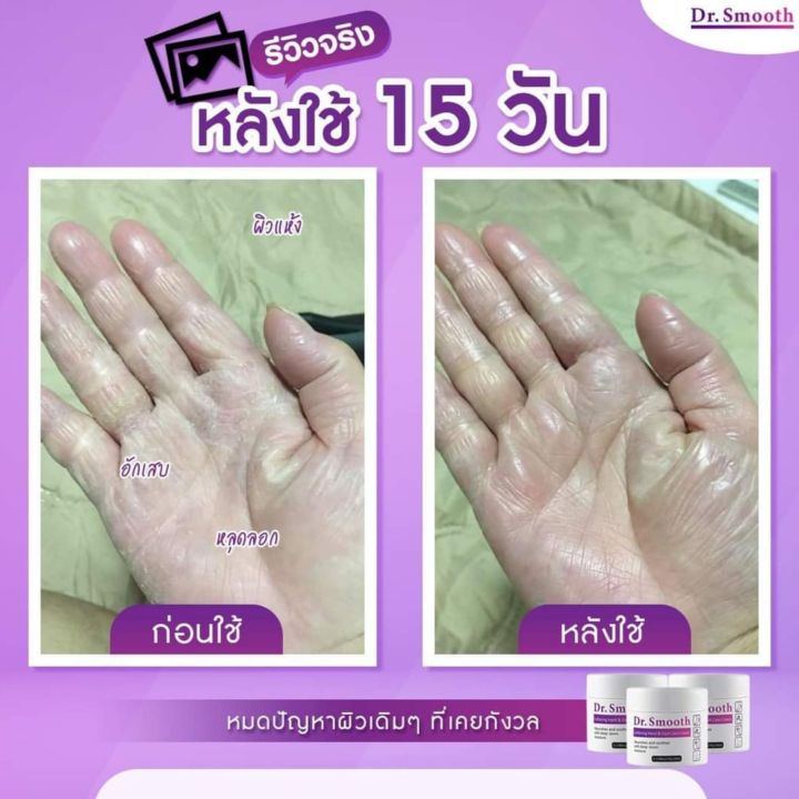 ครีม-dr-smooth-แก้ปัญหาผิวลอก-เท้าแห้งกร้าน-รอยดำ-ผดผื่น