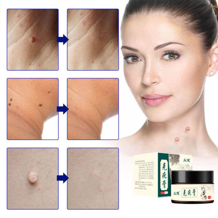 Warts Remover Antibacterial Ointment Wart Treatment Cream Skin Tag