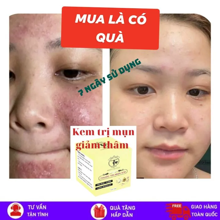 Thuốc trị mụn hàng đầu thuốc trị mụn x10 hiệu quả và an toàn