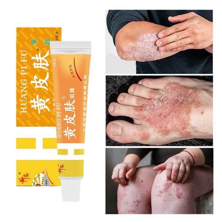 Yellow skin and rotten feet Antiitch and antibacterial cream Inner