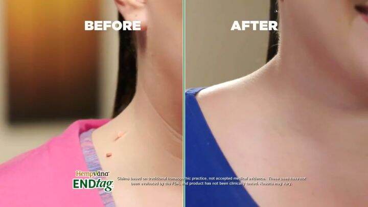 Seagril-concentrated Potent Skin Tag Removal Cream vivilucky Concentrated potent skin tag removal cream Body Warts Cream