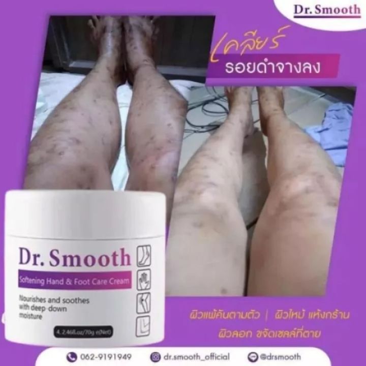 ยิ่งคัน-ยิ่งเกา-แนะนำๆ-dr-smooth-ดร-สมูท-ครีมทา-ดูแลปัญหา-ผด-ผื่น-ตุ่มแดง-ตุ่มใส-อาการคัน-ยิ่งเกายิ่งลาม-ขนาด-1-กระปุก