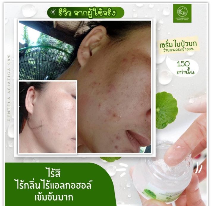 เซรั่มใบบัวบก-ลดสิว-ผิวผด-หน้าใสไม่หยุดคล้ำเสีย-กอบกู้ผิวไหม้จากแสงแดด