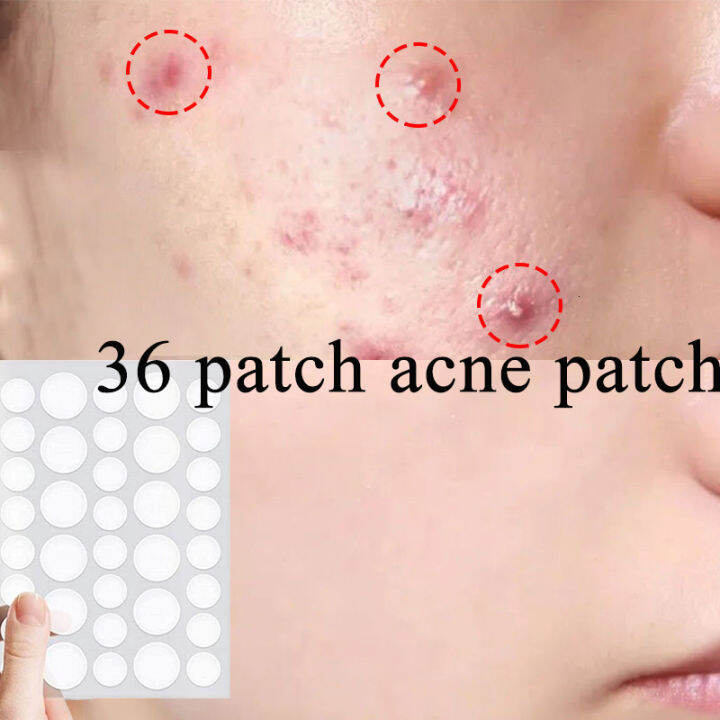 Korea 36pcs pimple patch sticker Original acne patch Acne remover Gel