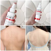 สเปรย์สิว ACNE-EX Body Spray ช่วยยับยั้งแบคทีเรีย สาเหตุของการเกิดสิว