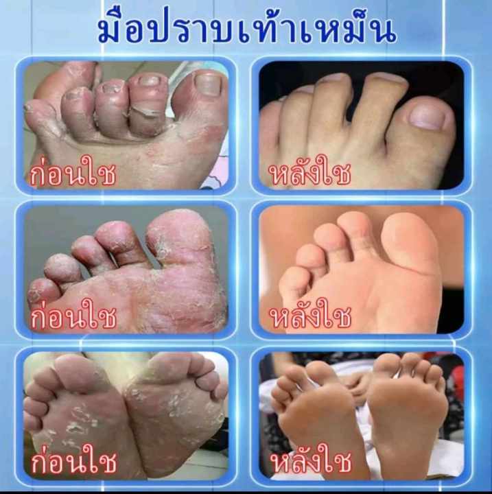sumifun-ครีมทาลดกลิ่นเท้า-ยาแก้ปวด-ครีมระงับกลิ่นเท้า