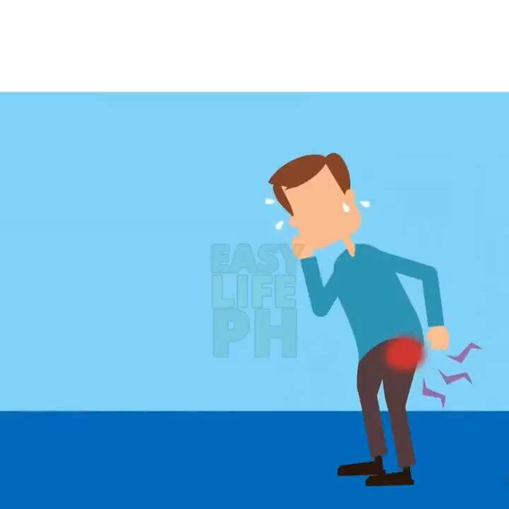 Hemorrhoid Ointment Internal Hemorrhoids External Hemorrhoids Mixed