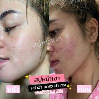 สบู่หน้าเงา สบู่เซรั่มของแท้? ปรับผิวหน้าให้กระจ่างใสขาวขึ้น ลดรอยจุดด่างดำ ลดปัญหาการเกิดสิว ผิวแพ้ง่ายใช้ได้