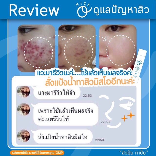 แป้งน้ำทาสิวมิสโอ-miss-o-ลดสิว-สิวอักเสบ-ผดผื่น-สิวอุดตัน-ผิวแพ้ง่ายใช้ได้