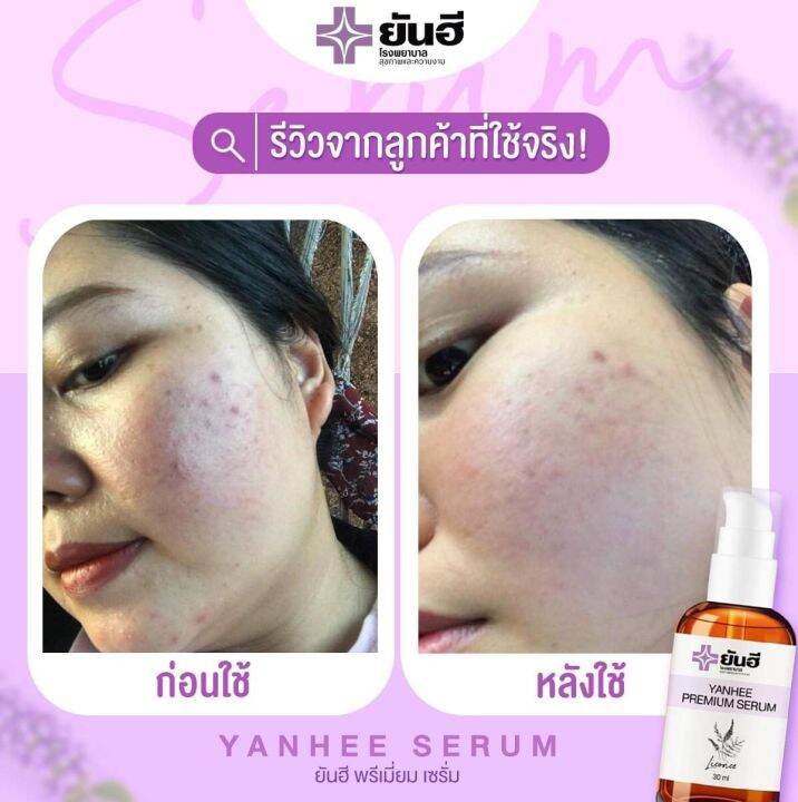 ยันฮีเซรั่ม-yanhee-premium-serum-ลดฝ้า-กระ-จุดด่างดำ-ได้อย่างมีประสิทธิภาพ-ราคา-390-บาท