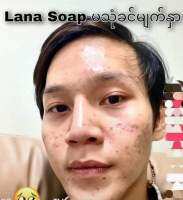 Lana Face Soap 5 pcs ( 5 ခဲ )