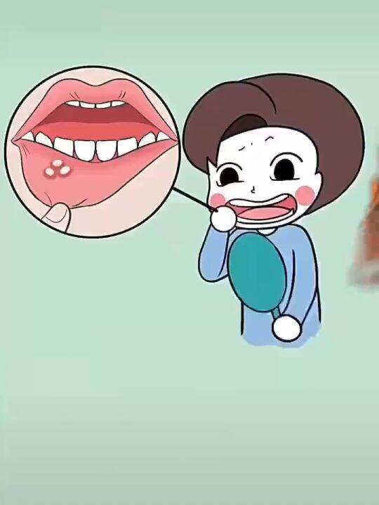 Mouth Ulcer Gel Quickly Repair Mouth Ulcer Wound Relieve Pain Fresh