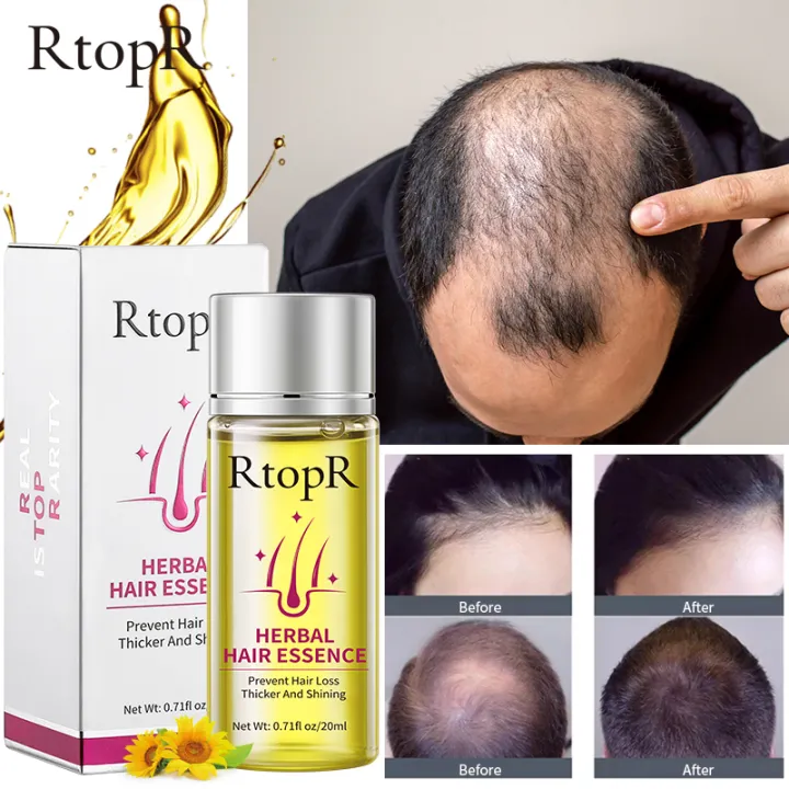 RtopR Herbal Hair Growth Anti Hair Loss Liquid Promote Thick Fast Hair  Growth Treatment 20ml Essential Oil Health Care Beauty Essence | Lazada PH