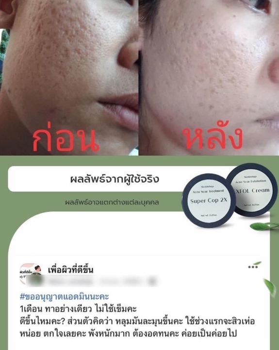 1-รักษาหลุมสิว-แบบเร่งด่วน-x2-เซ็ตคู่-รักษาหลุมสิวแบบเร่งด่วน-นำเข้าจากอเมริกา