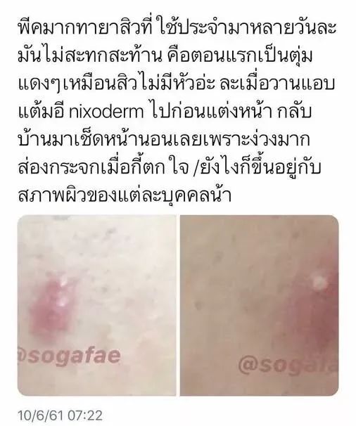 nixoderm-ครีมบรรเทาอาการสิวอักเสบ-สิวอุดตัน-สินค้าพร้อมส่ง