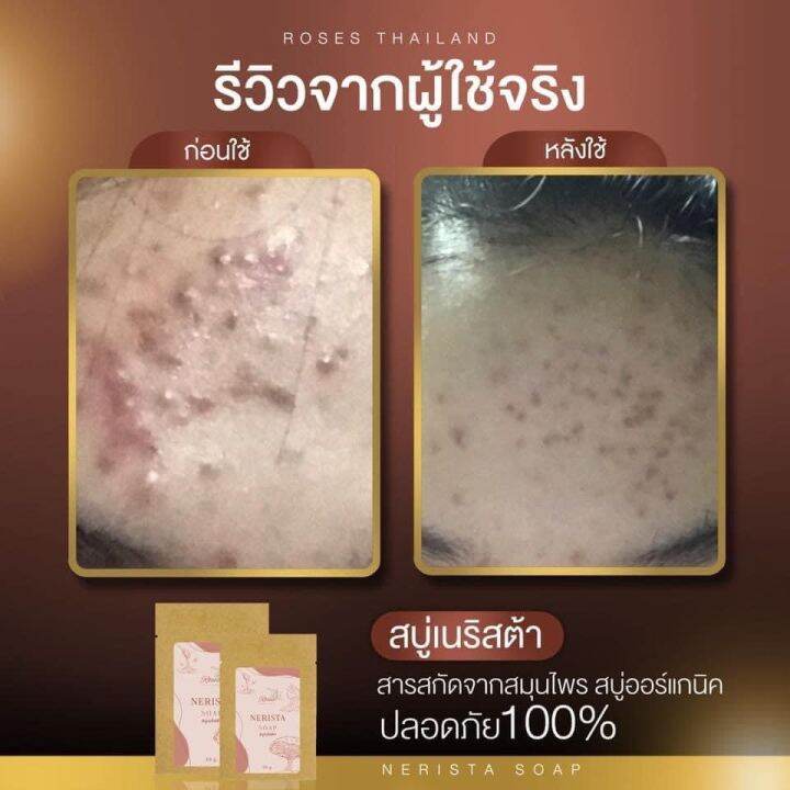 สบู่เนริสต้า-ลดสิวทุกชนิด-หน้าติดสาร-หน้าใส-ฝ้า-กระ-จุดด่างดำ-แพกเกจใหม่