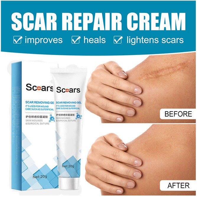 Effective Scar Removal Cream Peklat removal Stretch Mark cream old Scar ...