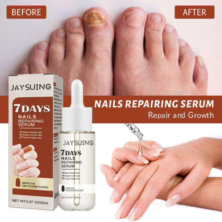 Ingrown Toenail Repair Essence Soften Nail Repair Thickening Fungal