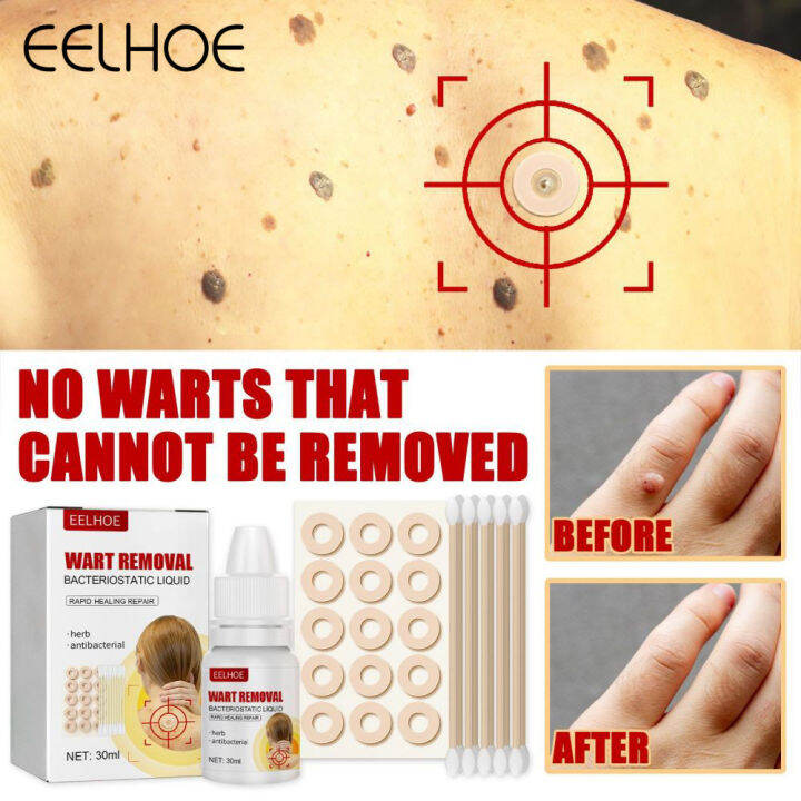 eelhoe Wart remover liquid 15 tablets/box Relieves pain, removes