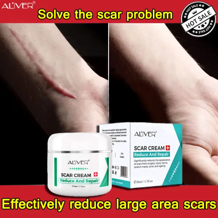 Let you not be troubled by scars! ALIVER Scar Removal Cream Acne