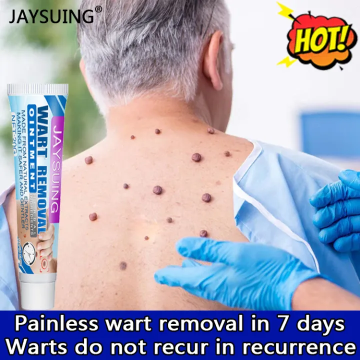 Are You Still Afraid Of Warts Blocking Your Beauty Jaysuing Wart are-you-still-afraid-of-warts-blocking-your-beauty-jaysuing-wart