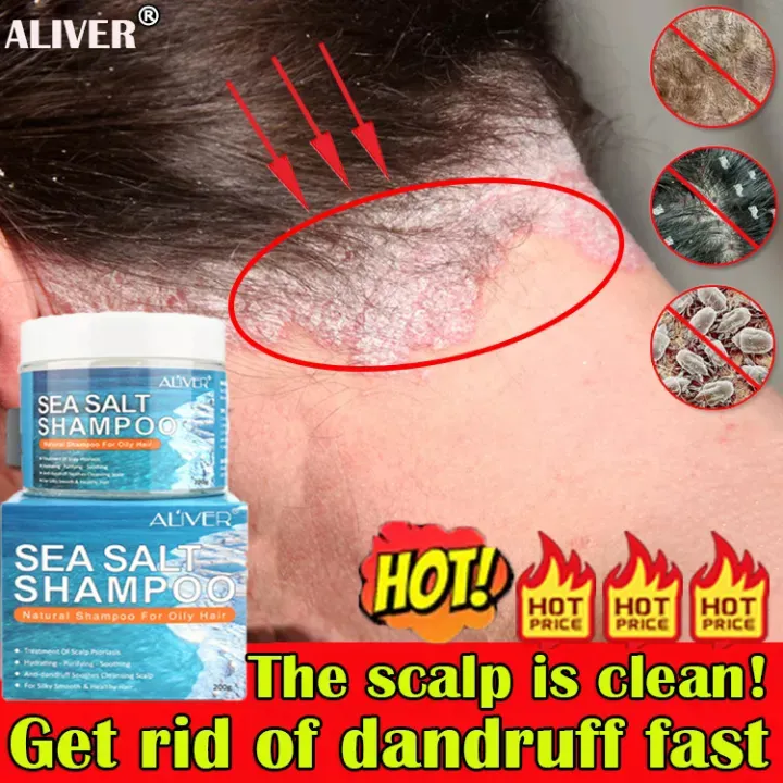 One time effect Aliver Sea Salt Anti Dandruff Shampoo Hair Treatment  Shampoo For Scalp Psoriasis Itching