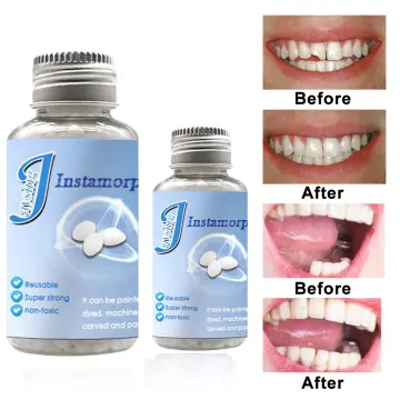 Private Label Teeth Gem Set Material Bonding Light Cure Adhesive 37%  Etchant Blue Gel Composite Tooth Gem Kit - Buy Teeth Gem,Tooth Gem,Tooth  Gem Kit