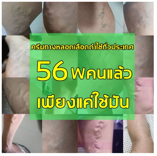 ผู้ขายในท้องถิ่น-sefudun-รักษาเส้นเลือดขอด-ยาทาเส้นขอด-เส้นเลือดขอด-50g-รักษาขาให้สวย-รักษาขาให้สวย-ครีมหลอดเลือดดำบอกลาเส้นเลือดขอด-คร